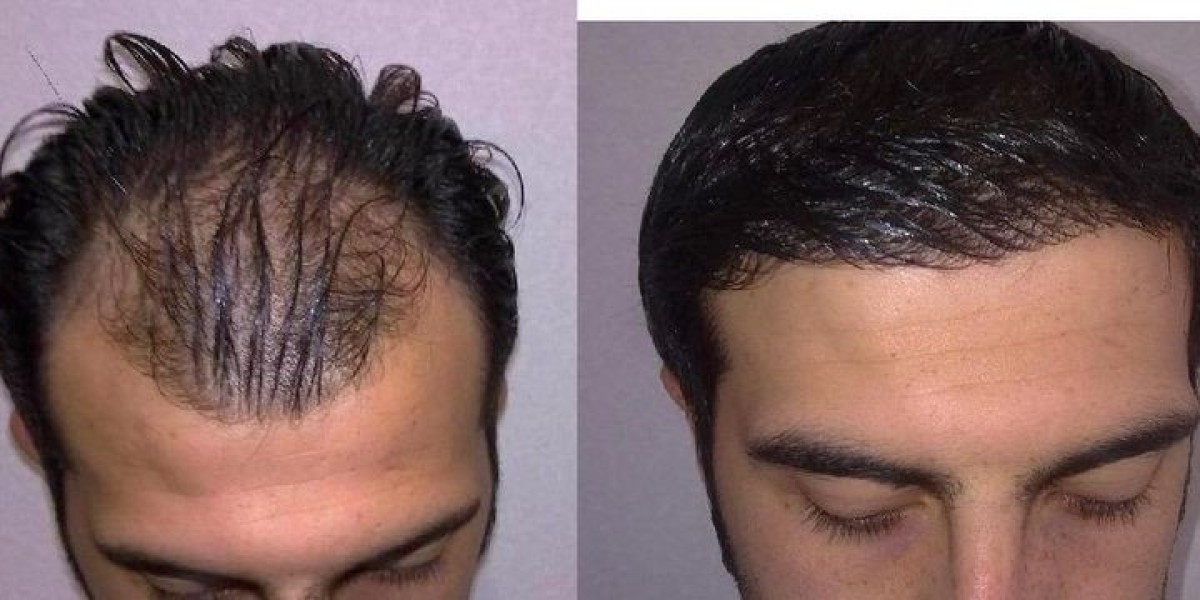 Hair transplant in Dubai Real Patient Experience Guide