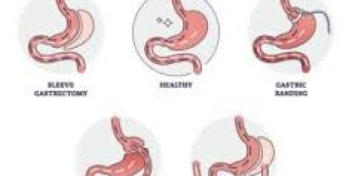 Understanding Gastric Sleeve Surgery in Dubai for Long-Term Weight Control