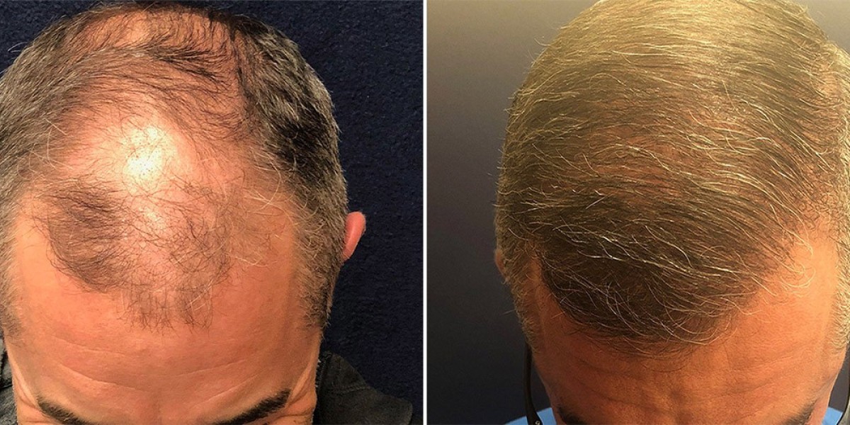 Hair Transplant in Dubai Density Expectations Guide
