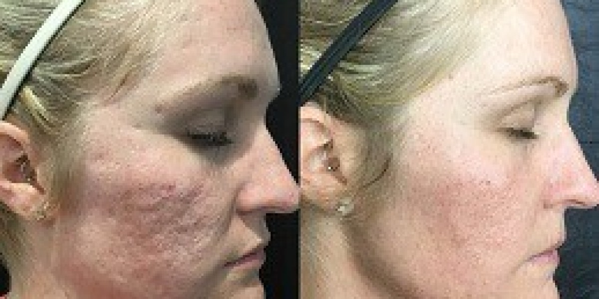 The Growing Popularity of Platelet-Rich Plasma (PRP) in Dubai