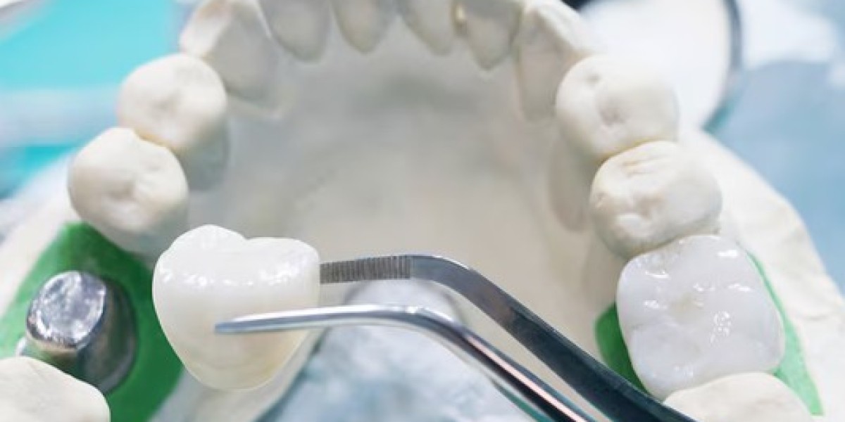 Get Beautiful Tooth Restorations Without Multiple Dental Appointments