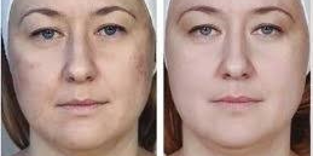 Why Mesotherapy for Bikini Area in Dubai Is Growing in Popularity