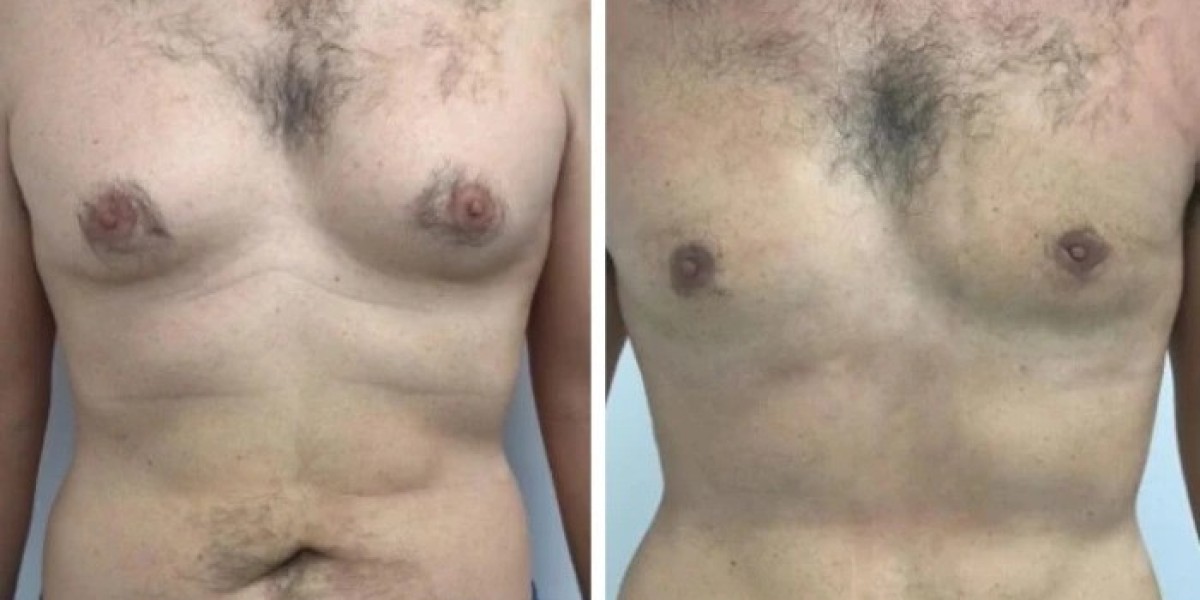 Latest Innovations Transforming Gynecomastia in Dubai Surgical Procedures