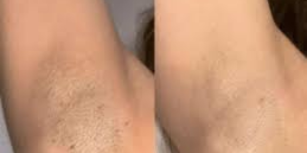 Body Hair Removal in Dubai: A Complete Guide to Smooth and Confident Skin