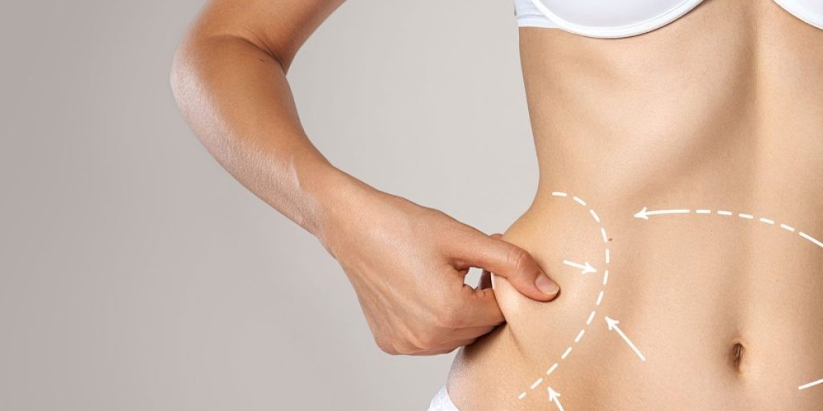 How Liposuction in Islamabad Supports a More Sculpted Appearance