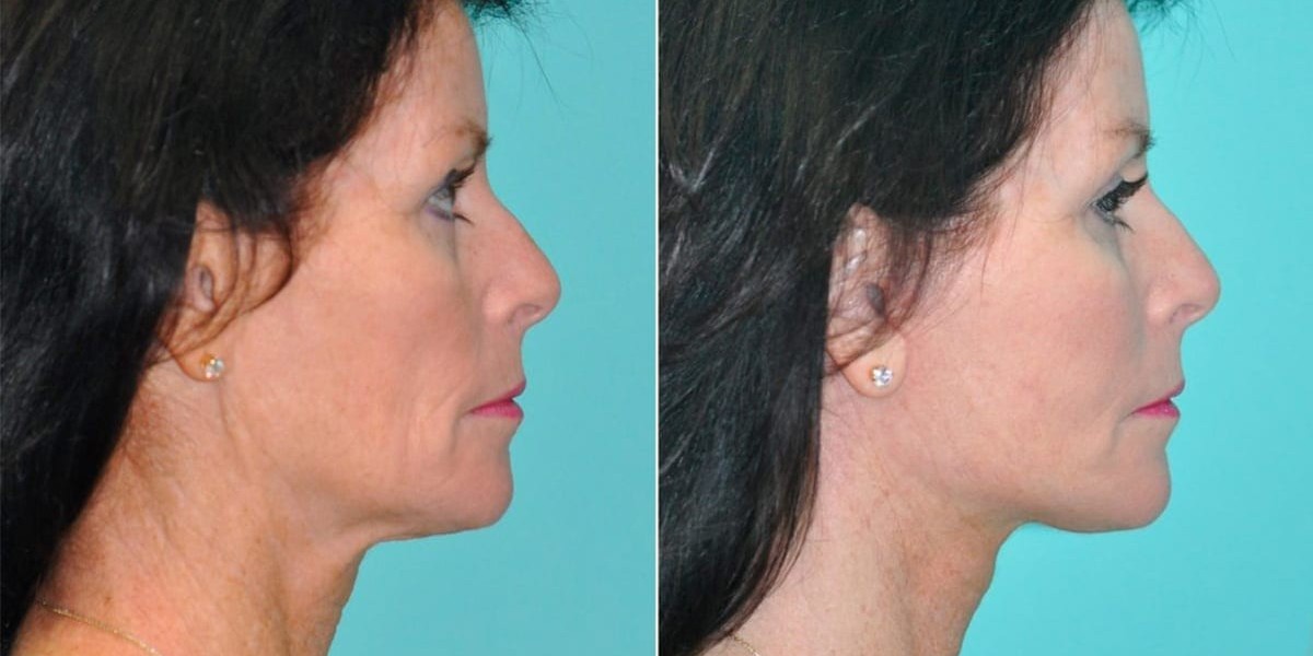 Benefits of Neck Lift Surgery in Dubai Explained