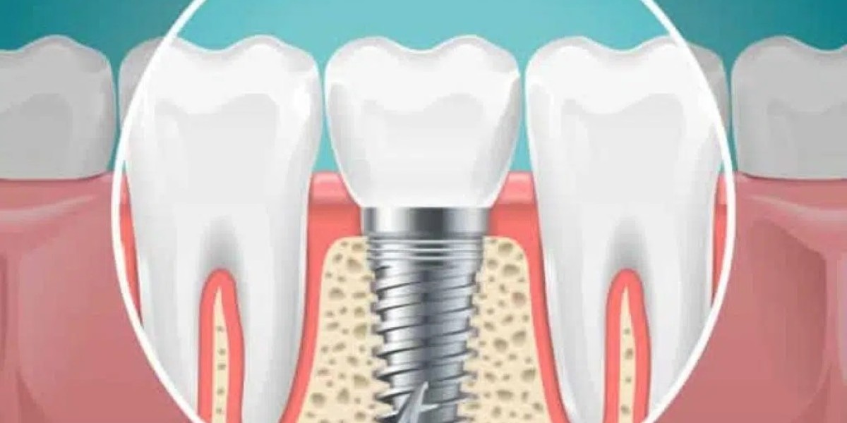 Why Dental Implants Brisbane Are Transforming Modern Tooth Replacement Options