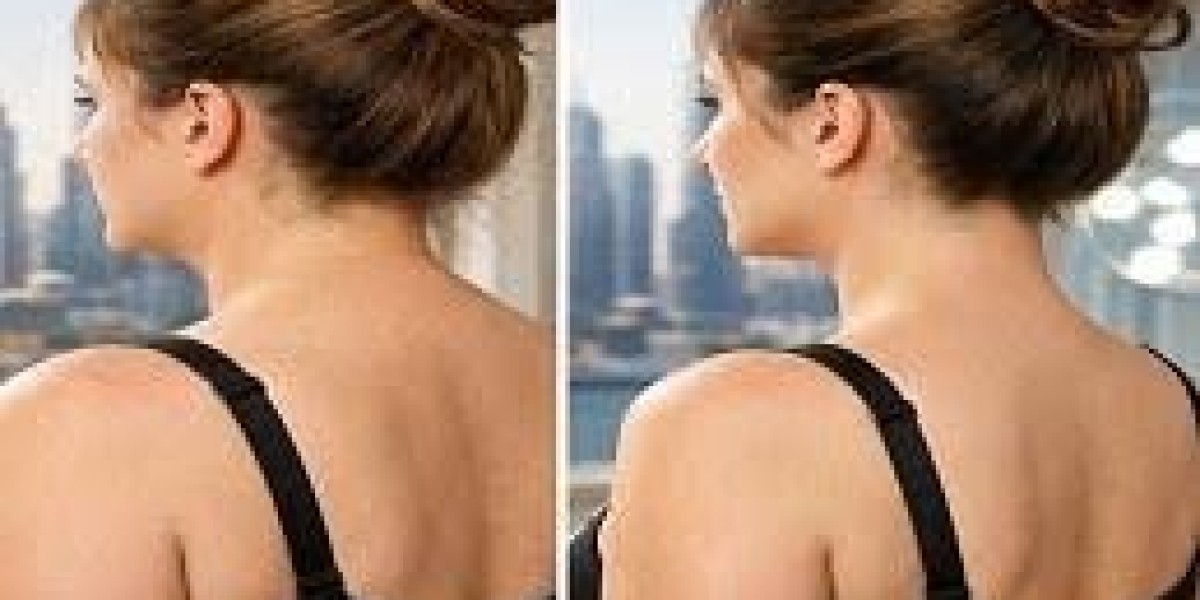 Why More People Choose Buffalo Hump Removal in Dubai | Comprehensive Guide