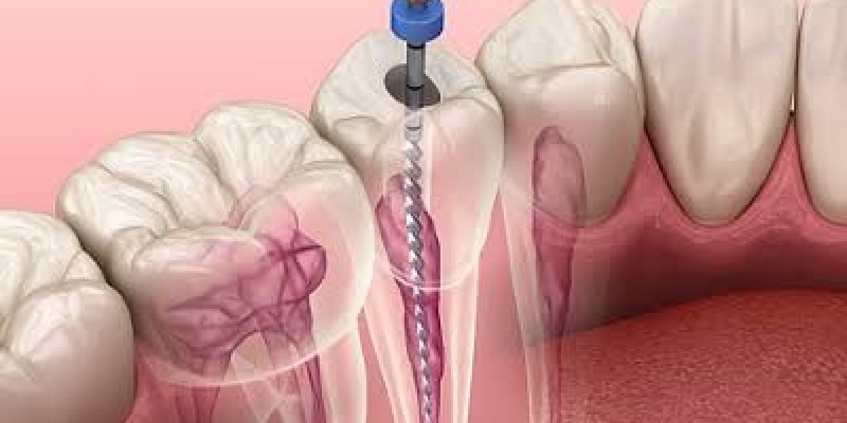 Root Canal Treatment in Dubai: A Complete Guide to Saving Your Natural Tooth