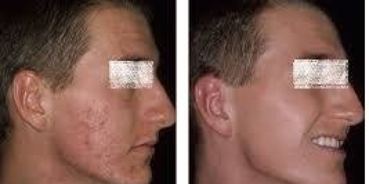 Scar Removal in Dubai: A Complete Guide to Smoother Skin