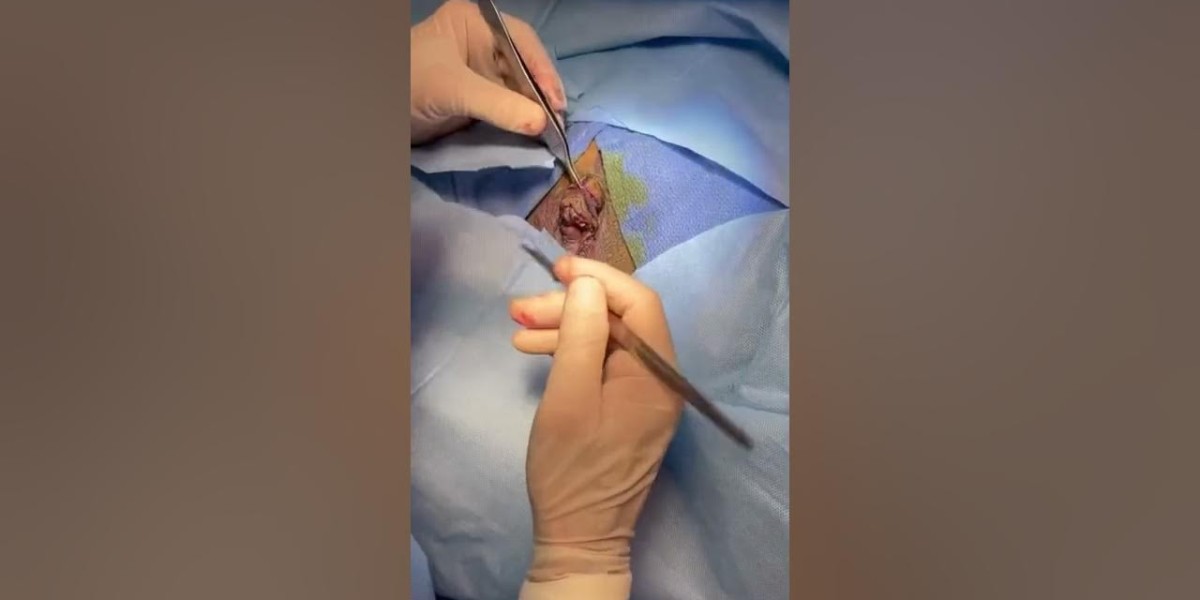 Professional Cosmetic Labiaplasty in Riyadh