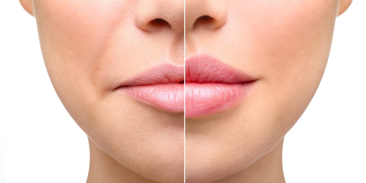 Reversing or Adjusting Lip Fillers: What You Need to Know
