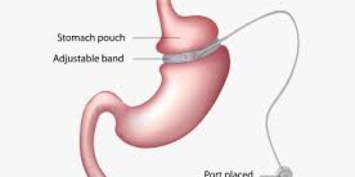 A Complete Guide to Gastric Sleeve Surgery in Dubai for Long-Term Weight Loss