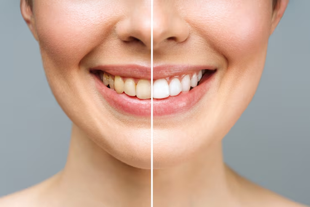 A Brighter Smile Starts with the Right Whitening Approach