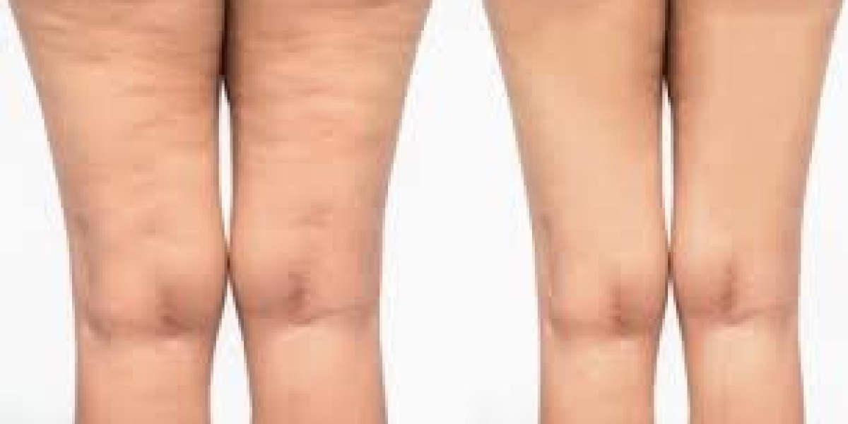 Why Cellulite Treatment in Dubai Is Growing in Popularity | Smooth Skin Solutions