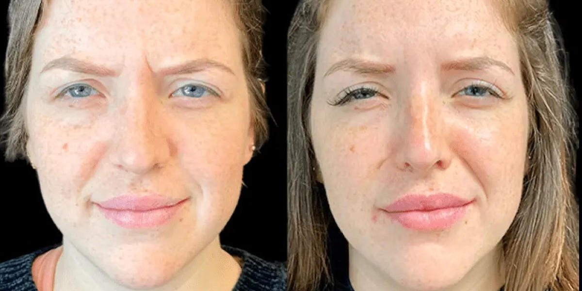 Best Doctors in Dubai Explain How Long Botox Results Typically Last