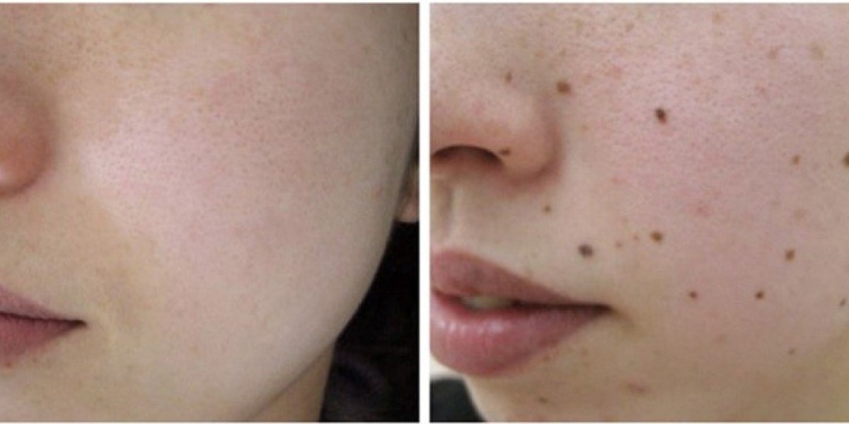 Mole Removal in Dubai Painless Mole Removal Options Today