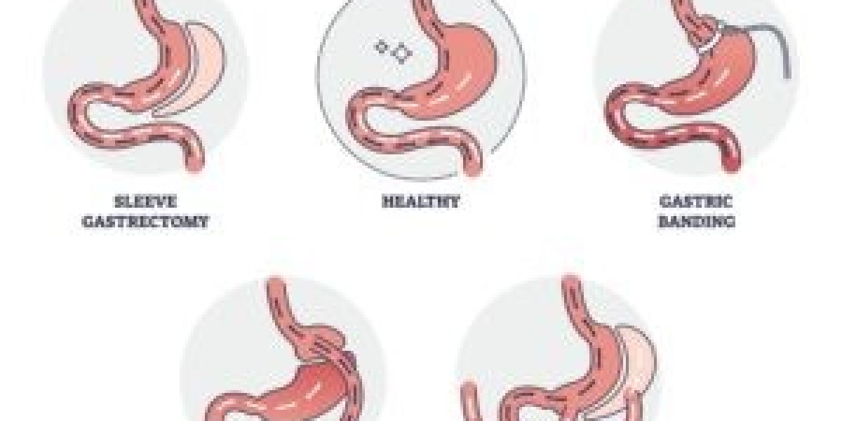 A Complete Guide to Gastric Bypass in Dubai for Long-Term Weight Loss