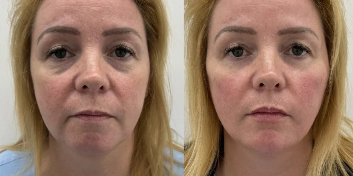 Golden Tree Collagen Derma Lift Switzerland