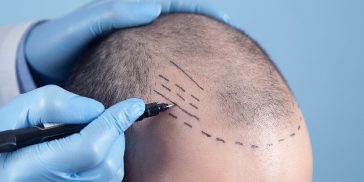زراعة الشعر في الدمام واستعادة كثافة الشعر