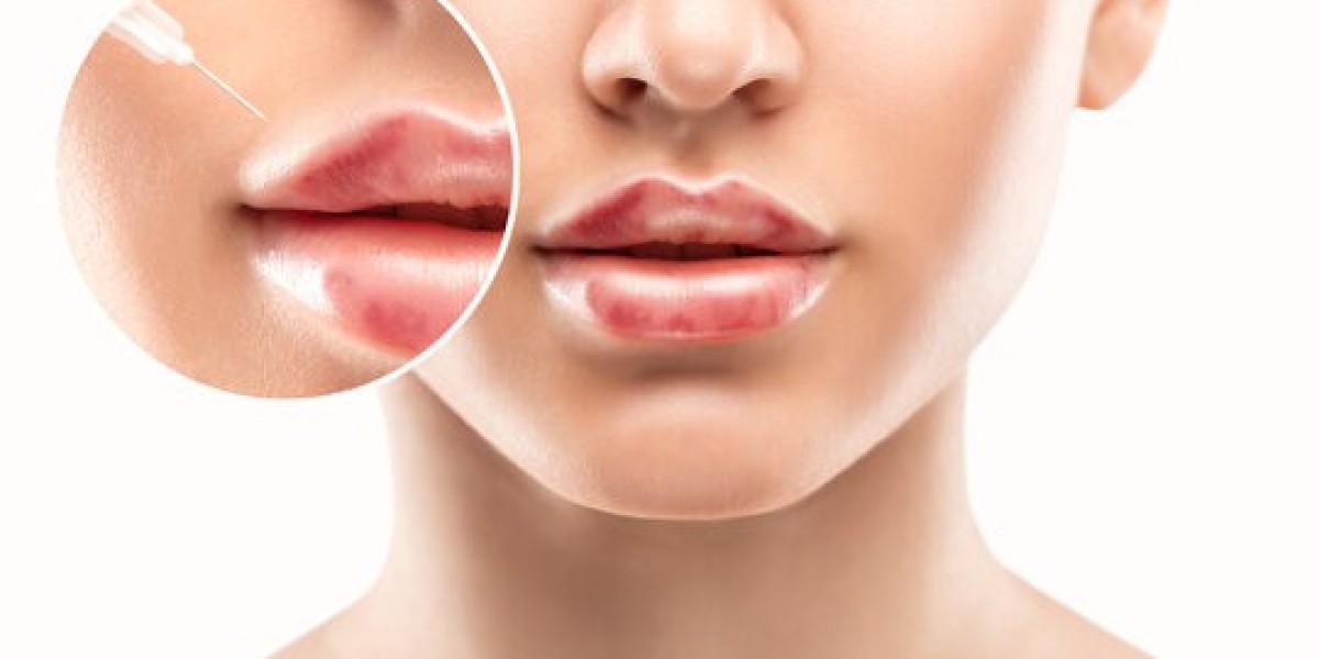 From Classic to Russian: Choosing Your Lip Augmentation in Riyadh