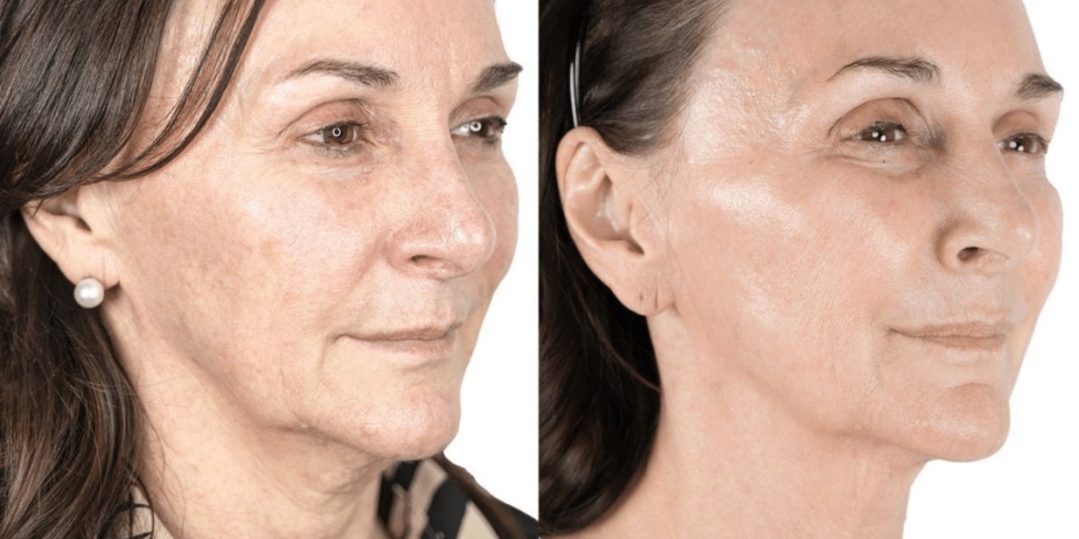 Golden Tree Collagen Derma Lift Germany