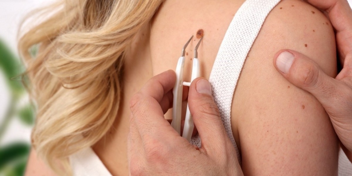 How Mole Removal in Islamabad Enhances Facial Symmetry