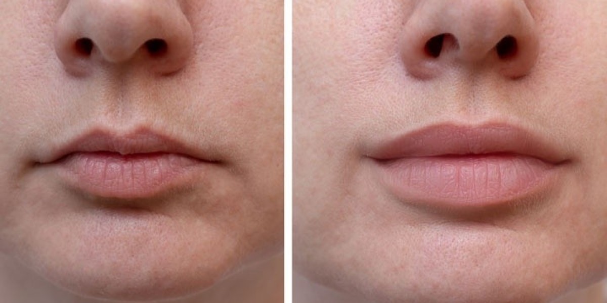 Anthropometric Precision: Calculating Volumetric Ratios for Absolute Facial Balance