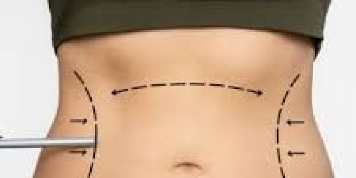Why Liposuction Surgery in Dubai Is a Popular Choice for Body Sculpting