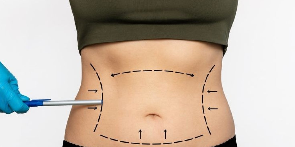 Mini Abdominoplasty in Dubai Minimal Scar Option