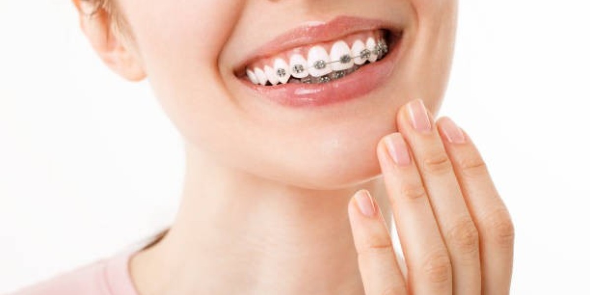 How Teeth Braces in Islamabad Help Create Healthy and Beautiful Smiles: