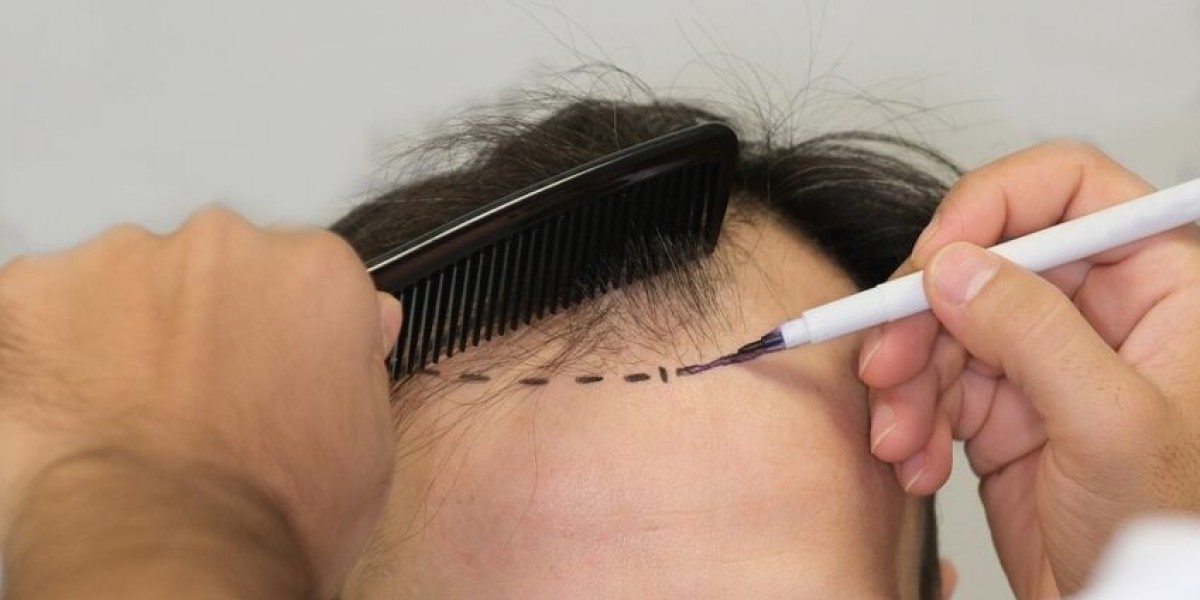 فترة التعافي بعد زراعة الشعر في الدمام