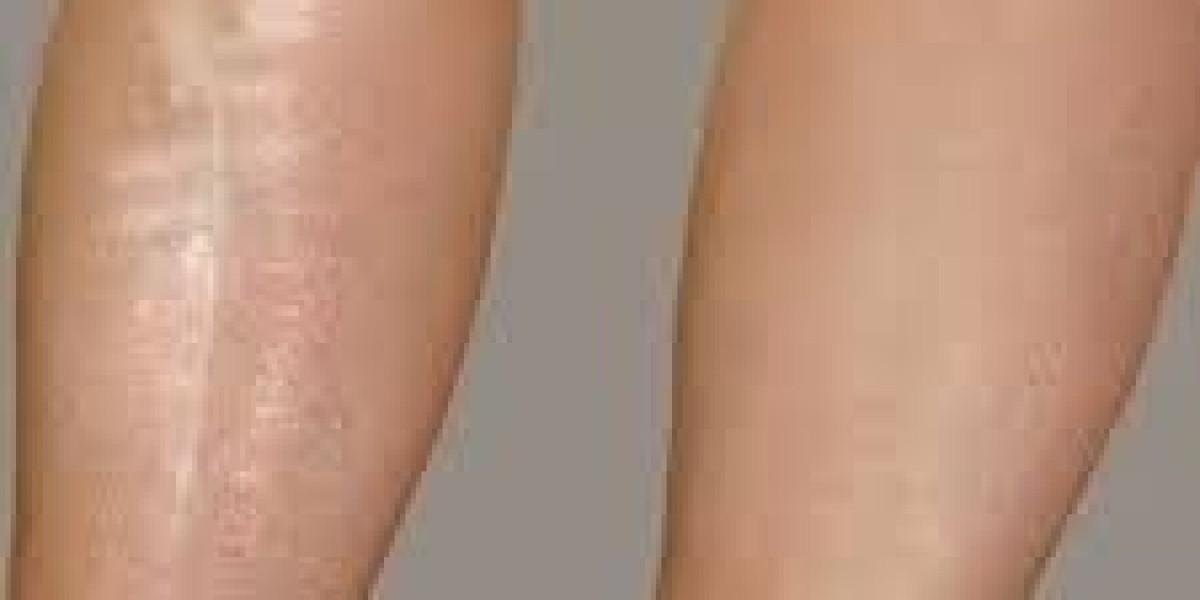 Leg Laser in Dubai | Enjoy Long-Lasting Smooth Skin