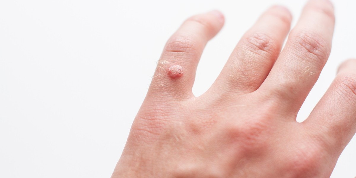 What Dermatologists Say About Laser Wart Removal in Dubai