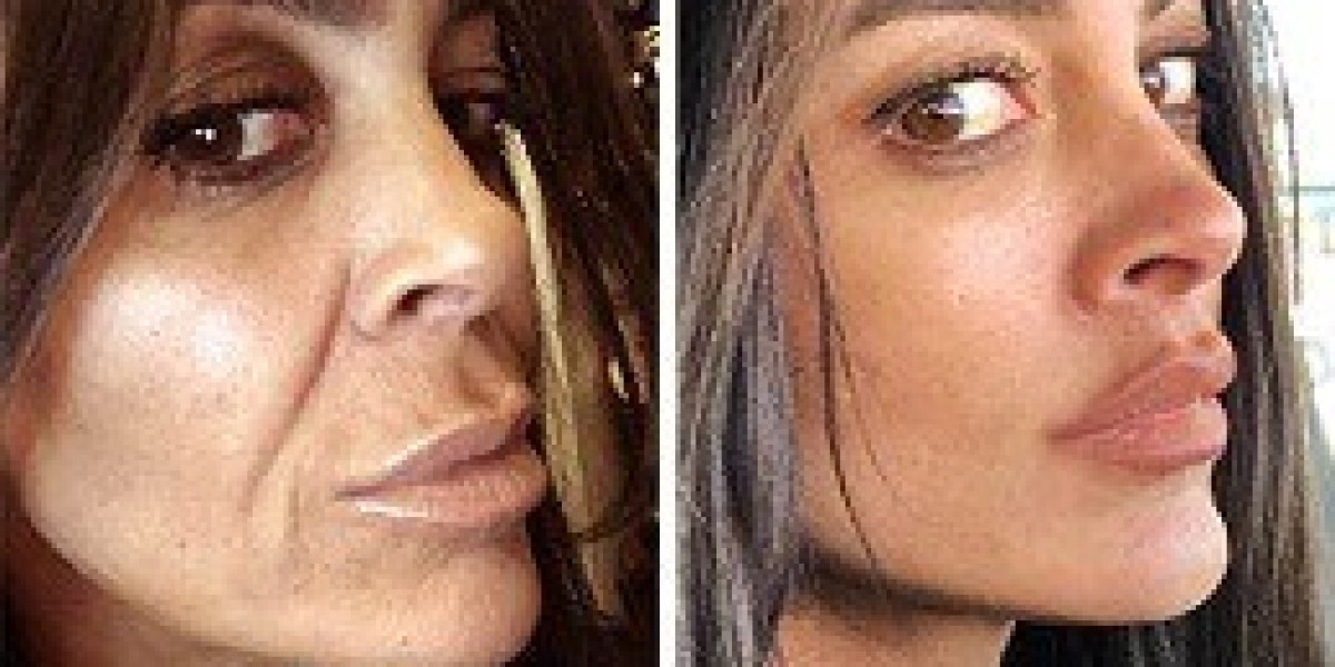 Best Plastic Surgeon in Dubai for Facial Aesthetic Enhancements and Natural Results