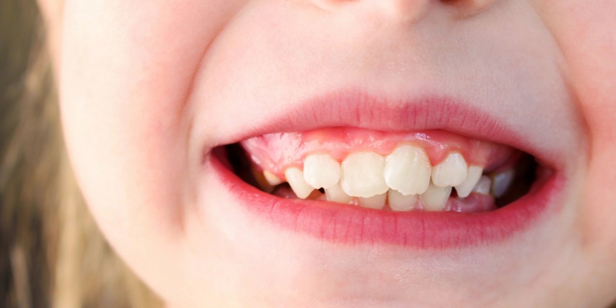 How Overlapping Teeth Treatment Can Improve Your Smile and Oral Health