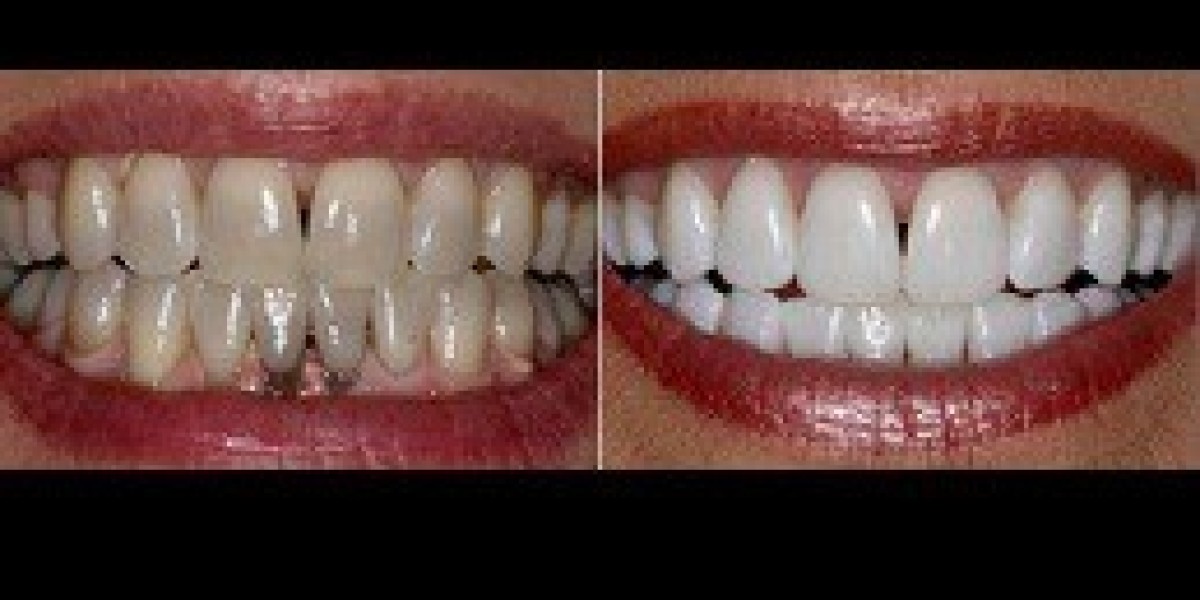 Zoom Teeth Whitening in Dubai: Safe, Fast & Effective Smile Brightening Solution