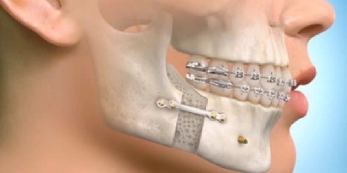 Precision Jaw Surgery Solutions in Islamabad at Glam Aesthetic Clinic