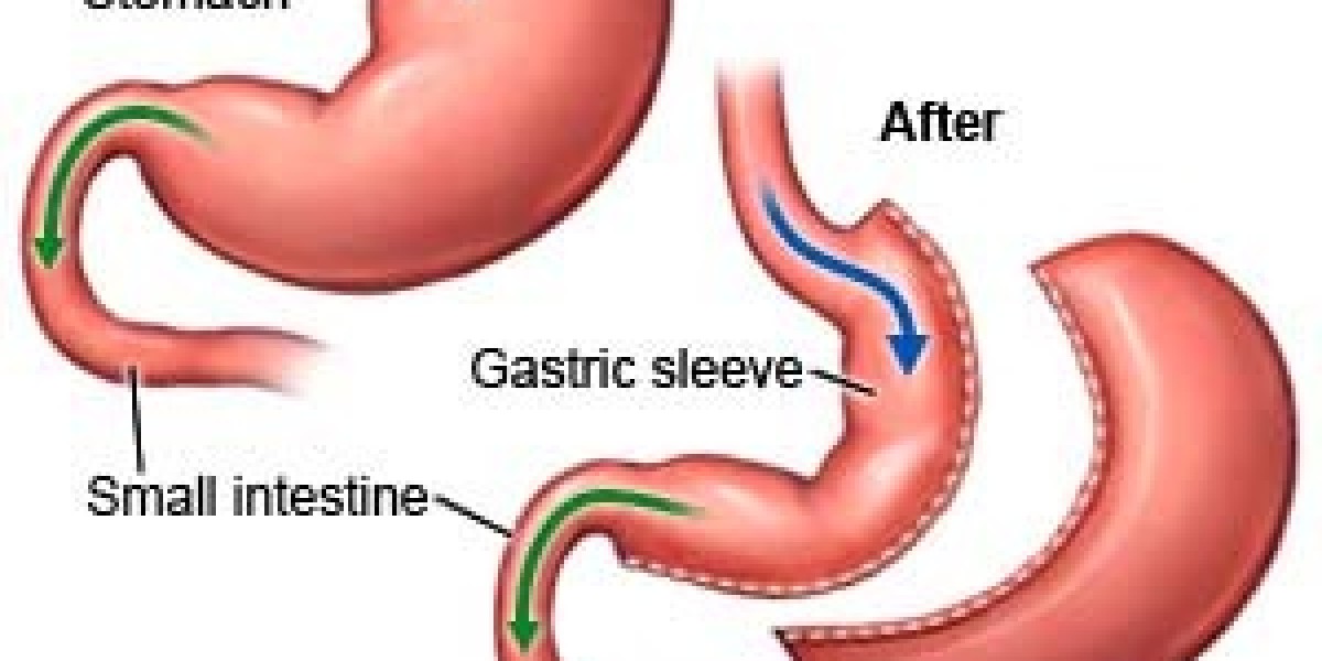 Laparoscopic Sleeve Gastrectomy in Dubai – A Modern Approach to Long-Term Weight Loss