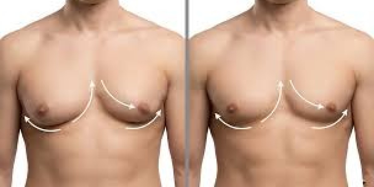 Gynaecomastia Surgery in Dubai: Benefits Explained
