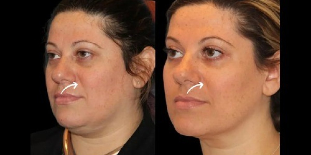 Best Doctors in Dubai Share Sculptra Fillers for Skin Adaptability
