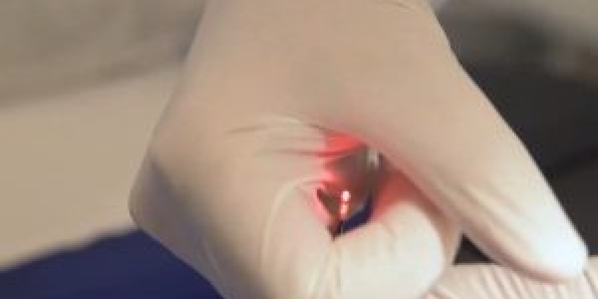 Why Laser Hemorrhoid Treatment in Dubai Is Becoming Popular
