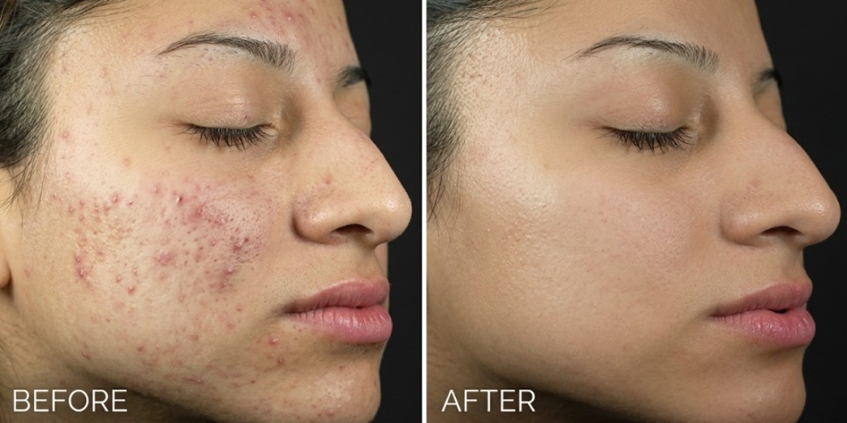 Achieve Flawless Skin with Scar Removal in Mississauga