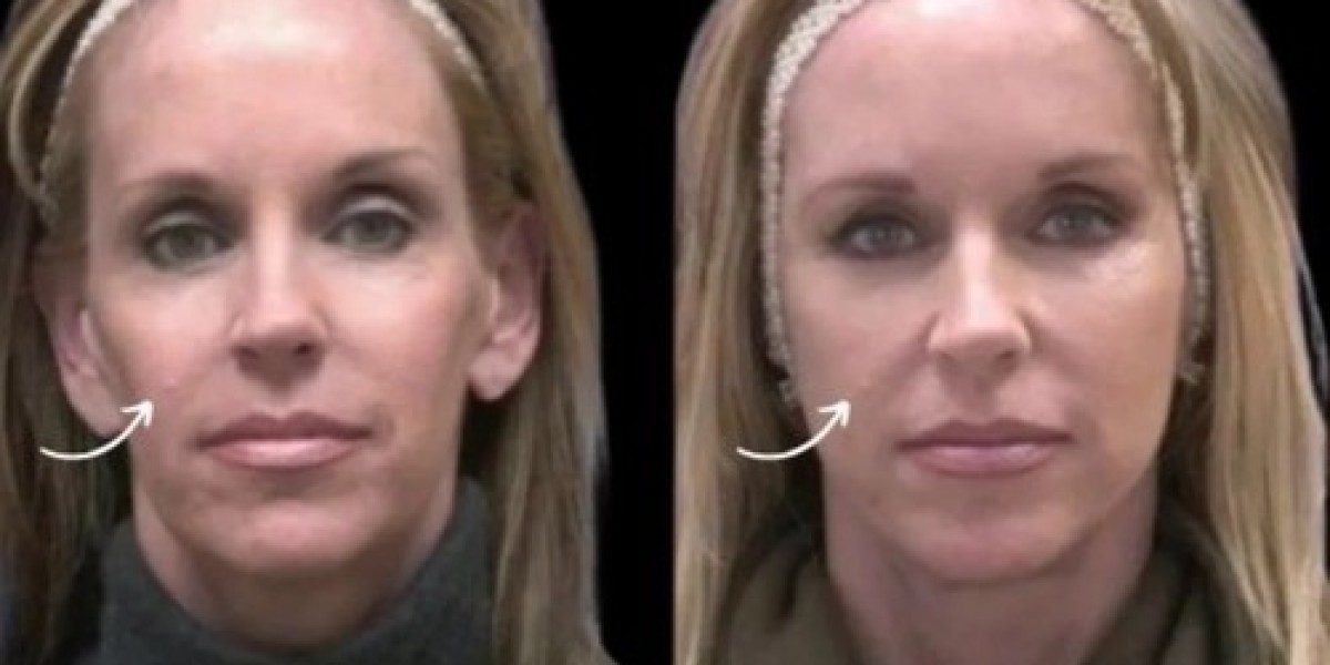 Best Doctors in Dubai Share Sculptra Volume Strategies