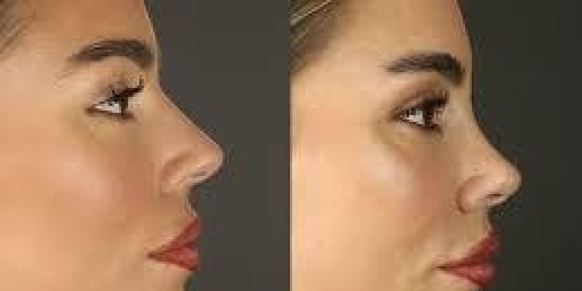 Can rhinoplasty fix breathing obstruction long-term?