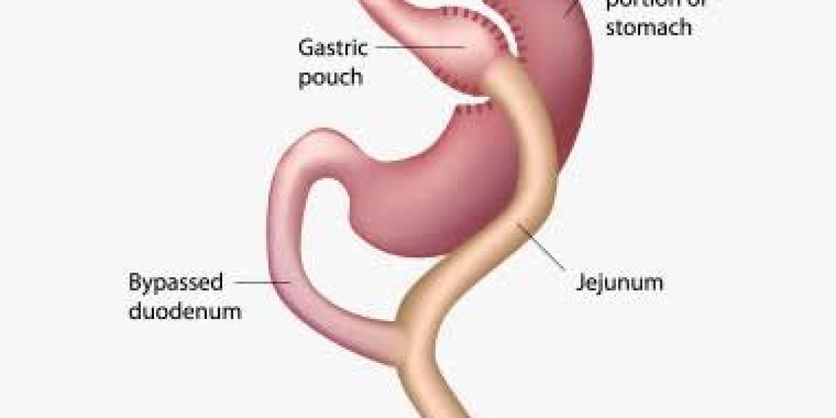 Gastric Bypass in Dubai: A Trusted Solution for Long-Term Weight Loss