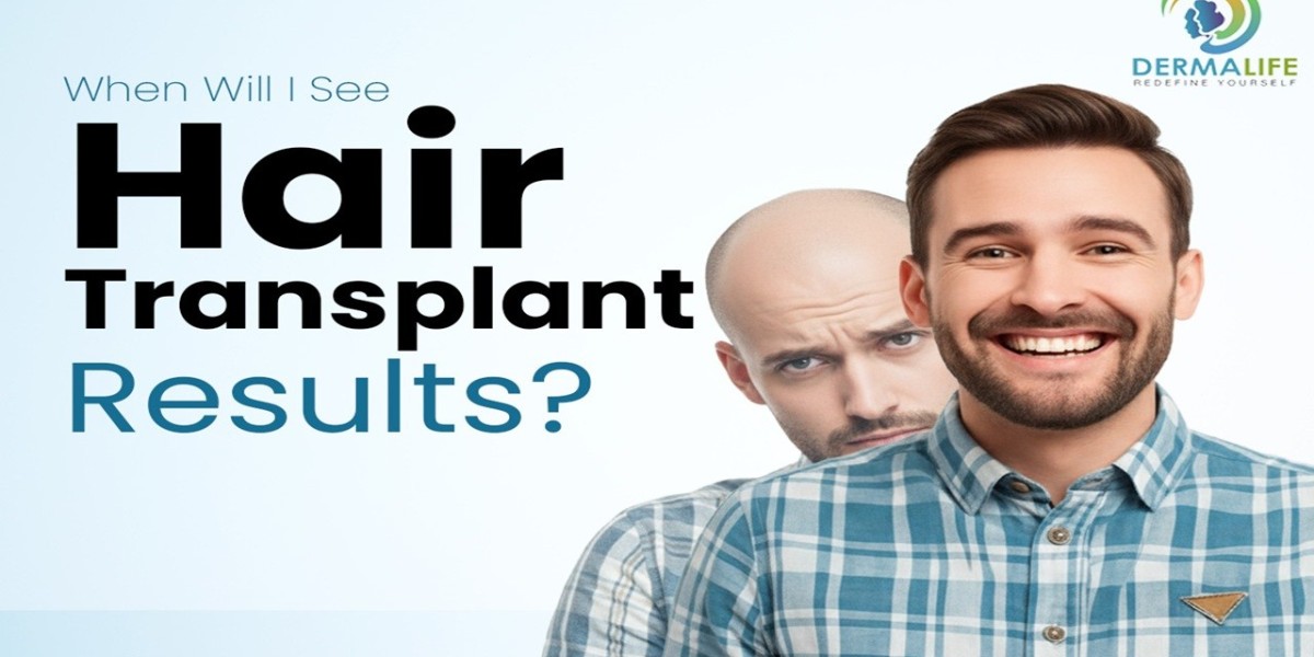 Every patient in Delhi, Noida & Gurgaon should know about Hair Transplant Myths vs Facts.