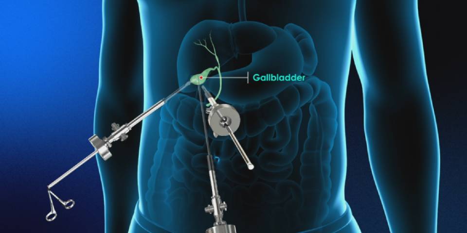 Gallbladder Stone Treatment in Bangalore | Dr. Bhushan Chittawadagi - Gallbladder Surgeon in Bangalore