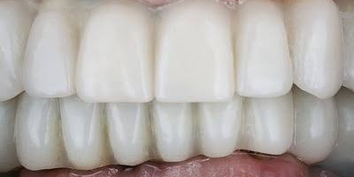 Dental Implants in Dubai: A Complete Guide to Restoring Your Smile
