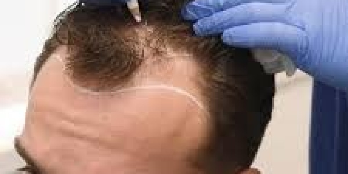 Hair Transplant in Dubai: A Complete Guide to Restoring Your Confidence